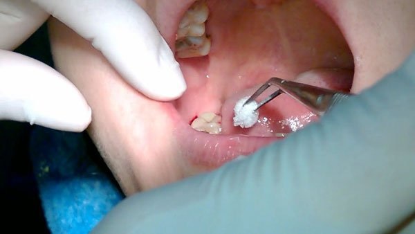 Sâu răng số 8 nếu không nằm ở mức độ nặng có thể xem xét chọn phương pháp hàn răng sâu để phục hồi răng.