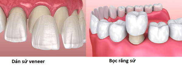 Sự khác nhau của dán răng sứ và bọc răng sứ