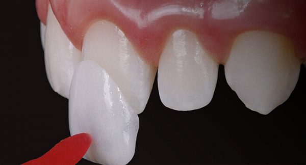 Dán răng sứ khá phổ biến dành cho răng bị hư tổn tương đối