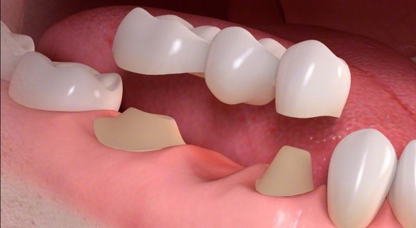 Trồng răng sứ có là dạng kỹ thuật nha khoa được áp dụng phổ biến hiện nay