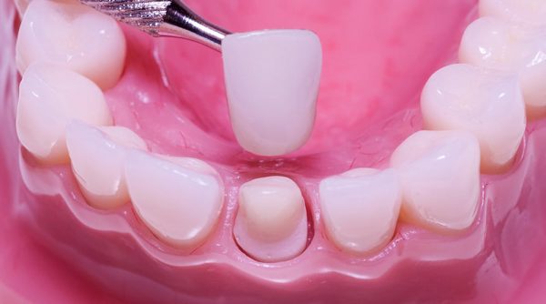 Trong quá trình trồng răng sứ các bác sĩ sẽ sử dụng ủ tê, gây tê giúp các bệnh nhân không bị đau đớn
