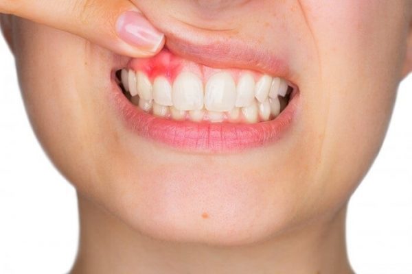 Viêm nướu răng là dấu hiệu của sự suy giảm sức khỏe răng miệng mà bạn không nên chủ quan