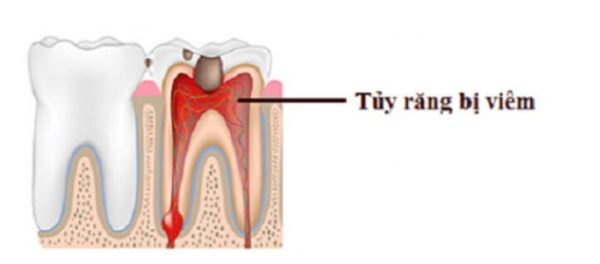 Chữa trị tủy răng với những trường hợp bị viêm hay nhiễm trùng tủy răng hay mô mềm bên trong ống tủy.