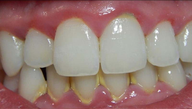 Mảng bám là một trong những tác nhân chính gây ăn mòn men răng với nhiều axit có trong đây.