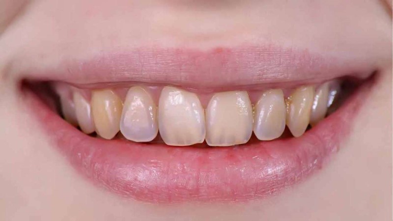 Những chiếc răng bị mất hoặc men răng bị ăn mòn thường có màu trắng hơn hoặc trong hơn những chiếc răng khác.