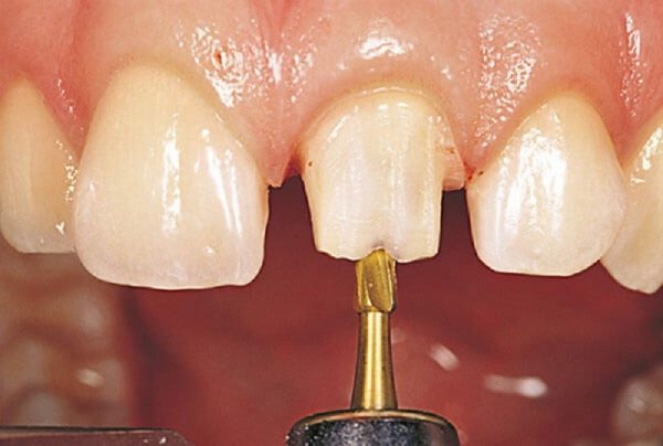 Mài nhỏ răng là phương pháp làm giảm độ dày của bề mặt răng tại phòng nha khoa nhằm thẩm mỹ hay chữa các bệnh về răng.