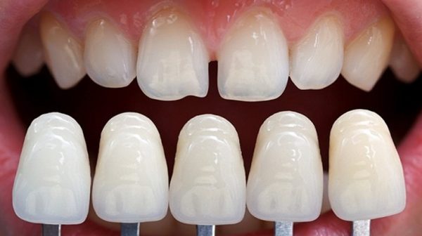 Mài nhỏ răng là phương pháp phổ biến được sử dụng khi thực hiện bọc răng sức. Răng sẽ được mài ở một tỉ lệ nhất định để tăng độ bám dính cho mão sứ.