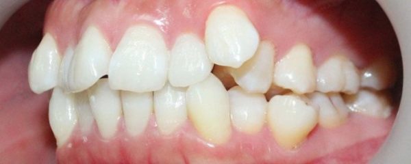 Bệnh cạnh phương pháp niềng răng cho những trường hợp răng mọc lệch thì người dùng có thể lựa chọn phương thức khác với hiệu quả nhanh hơn.