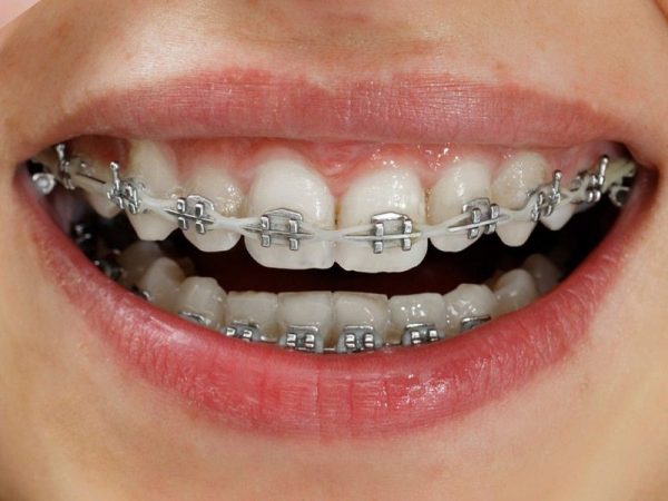 Niềng răng mặc dù không xâm lấn quá nhiều đến răng như sử dụng khí cụ gây mất thẩm mỹ cũng như thời gian lâu.