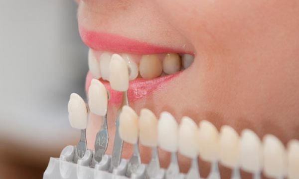 Bọc răng sứ là một phương pháp hay được sử dụng để giải quyết tình trạng răng cửa to bằng cách mà nhở răng và bọc sứ.