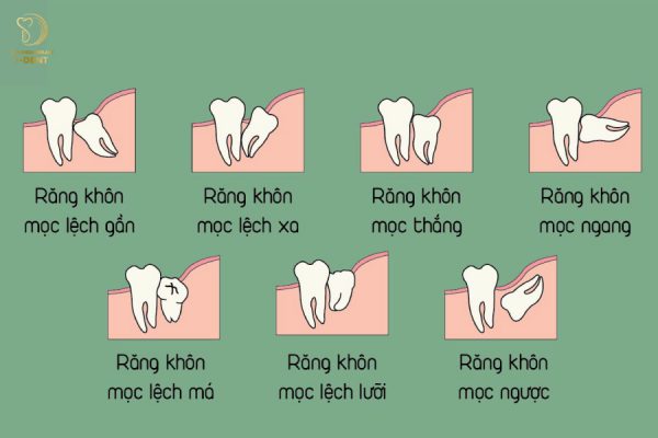 Mọc răng khôn và các bệnh lý về răng miệng là nguyên nhân hàng đầu khiến răng không sâu nhưng đau 