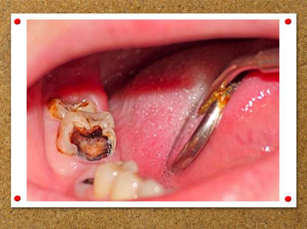 Răng sâu bị vỡ chỉ còn chân răng sẽ tạo nên lỗ hỏng lớn và dễ dẫn đến nhiều biến chứng nguy hiểm 