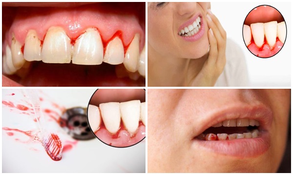 Sâu răng còn có thể gây chảy máu chân răng, lợi dễ bị sưng viêm, đau nhức 