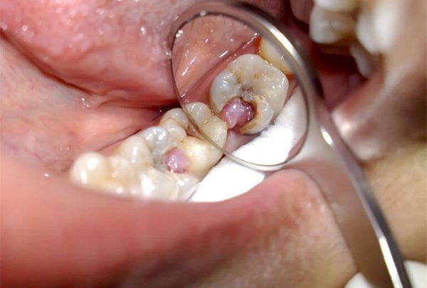 Sâu răng lồi thịt còn có thể làm ảnh hưởng đến những chiếc răng còn lại, gây viêm nhiễm và hoại tử 