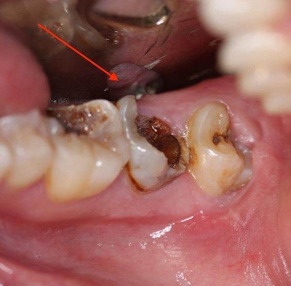 Răng sâu là tình trạng tổn thương men răng gây ra đau đớn cho người bệnh 