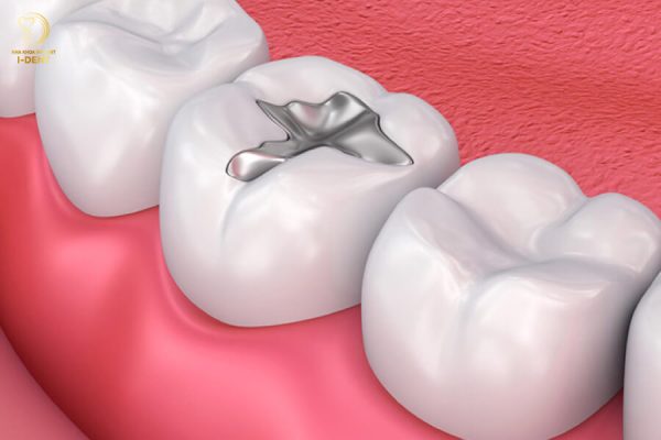 Trám răng là một trong những phương pháp phổ biến và được ưu tiên hàng đầu khi điều trị sâu răng 