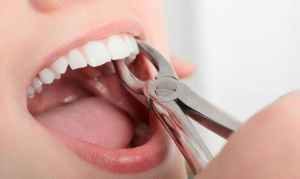 Nhổ răng là phương pháp loại bỏ những chiếc răng bị sâu nặng không thể khắc phục 