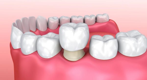 Bọc răng sứ là phương pháp có thể cải thiện tình trạng móm do răng, đem lại hiệu quả nhanh chóng. 