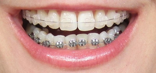 Niềng răng là phương pháp chỉnh nha an toàn tuy nhiên bạn cần phải tốn nhiều thời gian đeo niềng. 