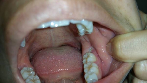 Chẳng may nhổ chân răng khi sót bạn cần nên đến thăm khám tại các cơ sở chuyên khoa để các bác sĩ theo dõi và điều trị 