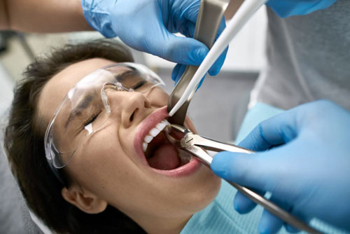 Nhổ răng là phương pháp thường được lựa chọn cuối cùng nhằm đảm bảo sức khỏe của những chiếc răng còn lại xung quanh khu vực răng lòi xỉ.