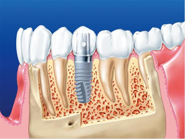 Trồng răng implant có gây đau nhức hay không?