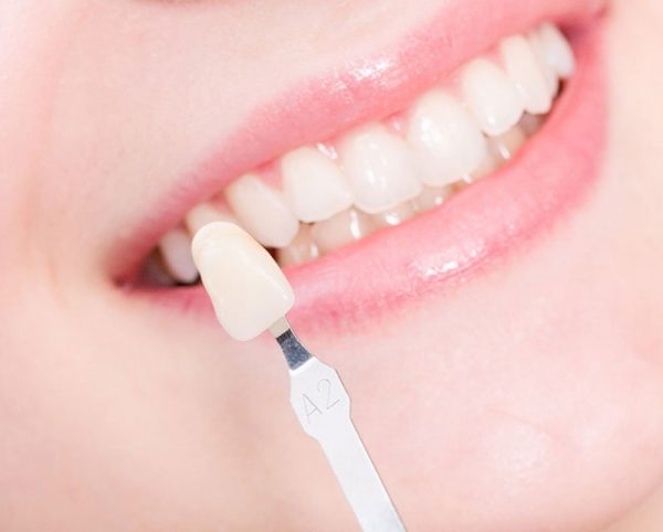 Bọc răng sứ và mặt dán sứ Veneer loại nào tốt hơn ?