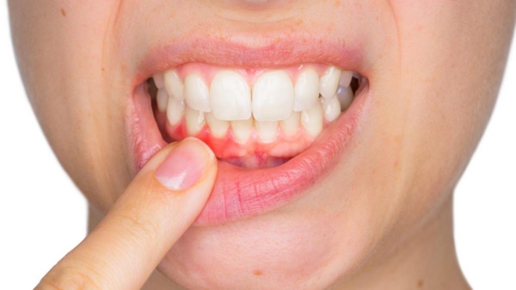 Nguyên nhân nào khiến nướu răng bị đỏ, sưng và đau?