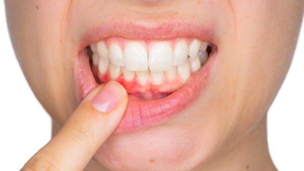 Nguyên nhân nào khiến nướu răng bị đỏ, sưng và đau?
