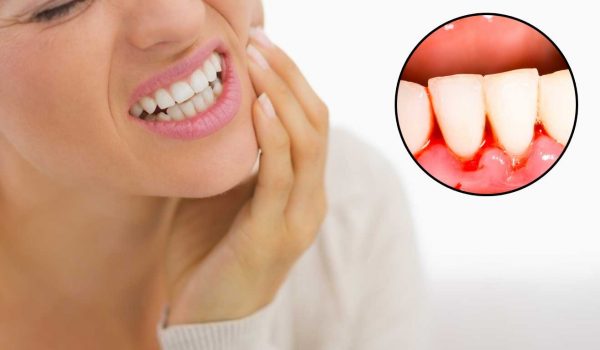 Các dấu hiệu nhận biết đang bị viêm nướu răng