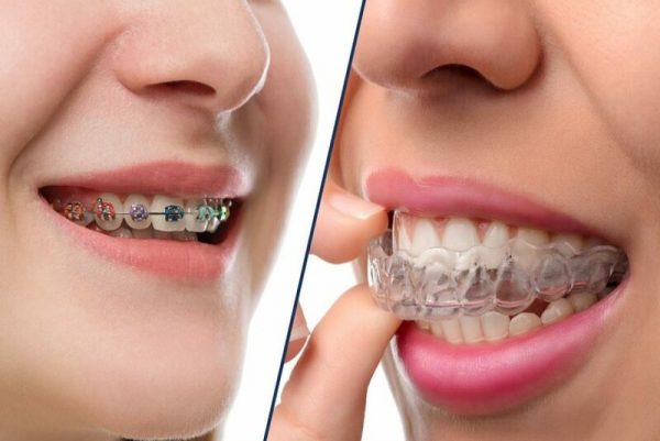 Tổng quan về kỹ thuật niềng răng chỉnh nha