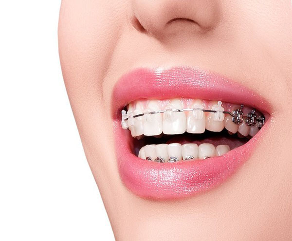 Các yếu tố nào tác động đến thời gian niềng răng ?