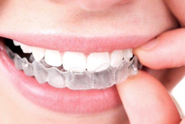 Ưu điểm tuyệt vời của phương pháp chỉnh răng Invisalign