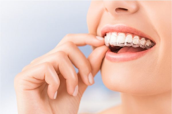 Niềng răng Invisalign thường mất 12 đến 18 tháng để đạt hiệu quả