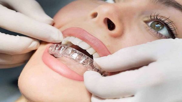Phải đảm bảo răng niềng đủ 22 giờ/ngày để tình trạng dịch chuyển răng diễn ra ổn định và không bị gián đoạn
