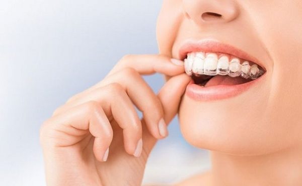 Niềng răng trong suốt liệu có đau, khác gì với niềng răng mắc cài truyền thống?