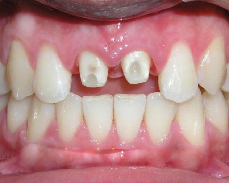 Răng sứ bị rớt ra ngoài gây mất thẩm mỹ, ảnh hưởng đến sức khỏe răng miệng