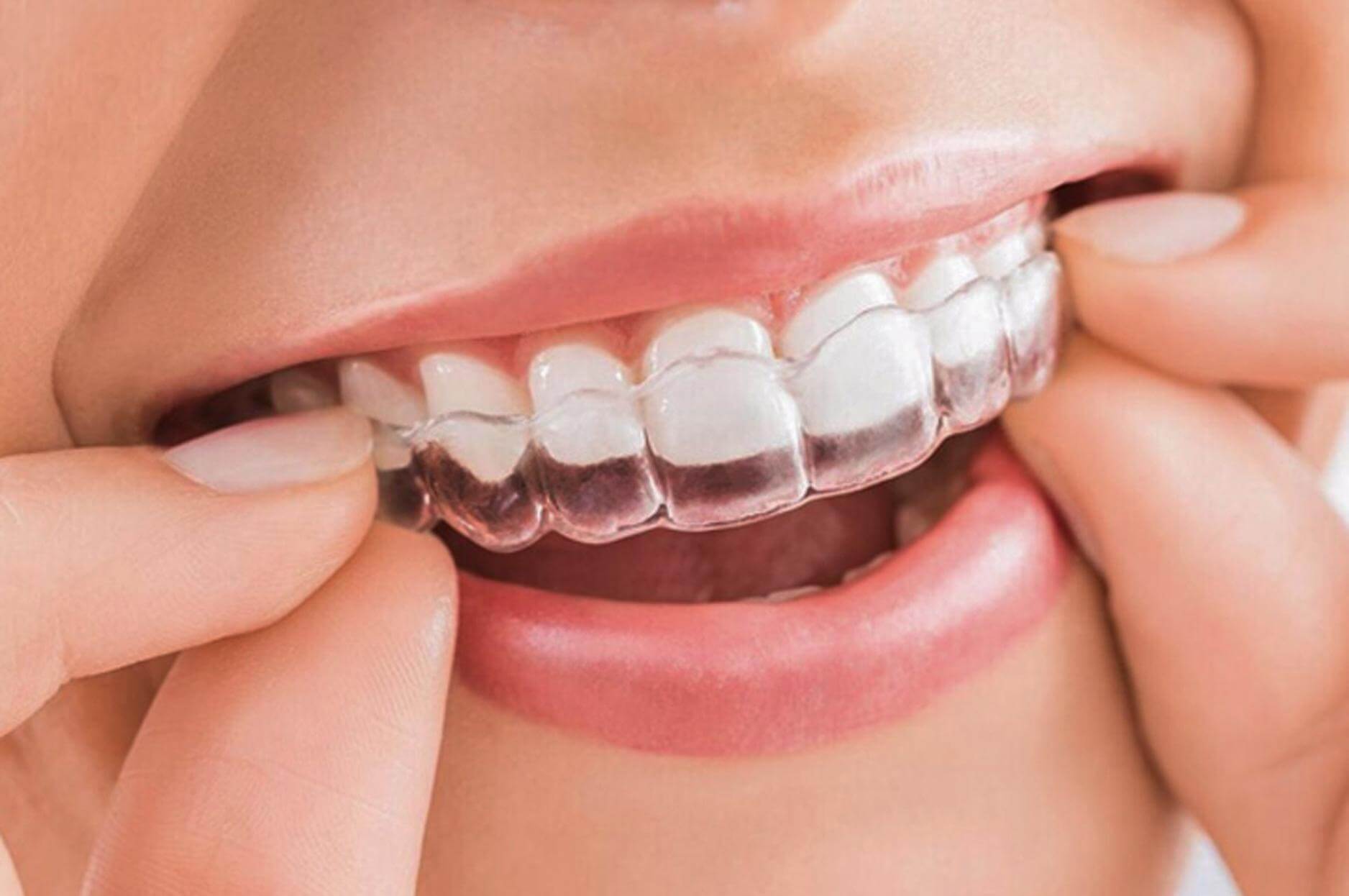 Cần làm gì trước khi tiến hành quy trình niềng răng Invisalign
