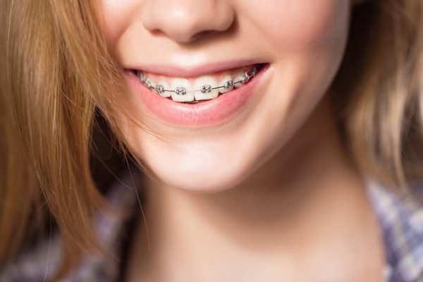Niềng răng không đều giúp cải thiện tình trạng răng mọc lệch