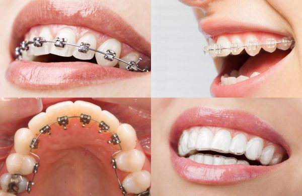 Có nhiều phương pháp niềng răng không đều