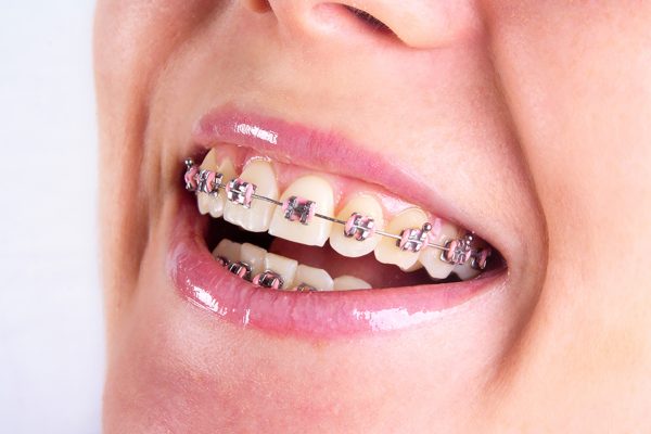 Cần lưu ý tuân thủ lời dặn bác sĩ khi niềng răng