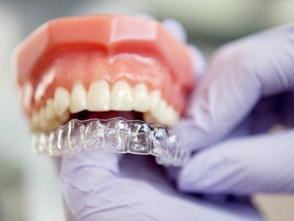 Niềng răng trong suốt mất bao lâu tùy vào tình trạng răng