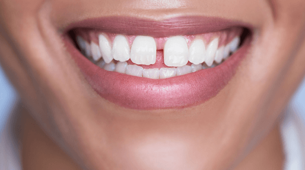 Nhổ răng trước khi niềng giúp sắp xếp các răng đúng cách