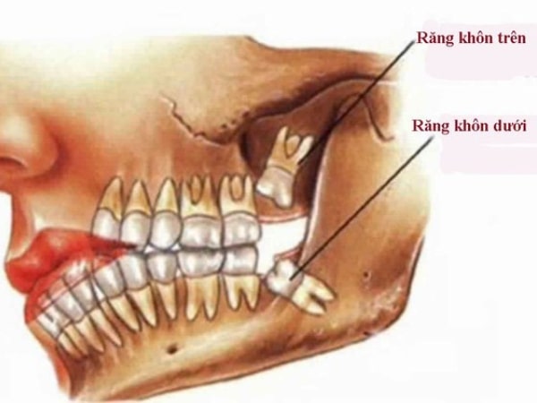 Trường hợp nào nên nhổ răng khôn hàm trên? - U nang xương hàm