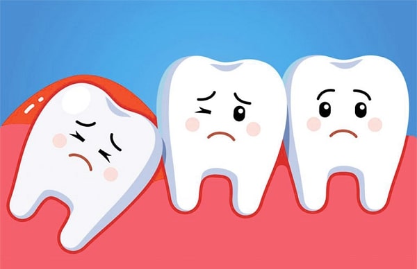 Lợi trùm răng khôn có thể tự hết không?