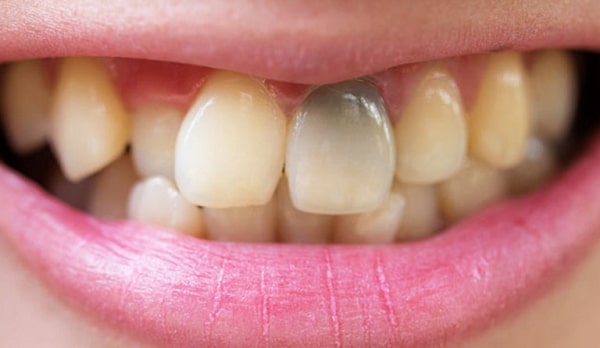 Răng chết tủy làm giảm sức nhai và mất cảm giác nhai nuốt