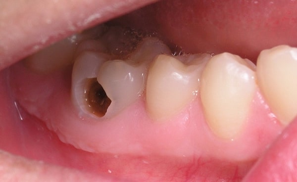 Nguyên nhân nào dẫn đến tình trạng răng chết tủy ?
