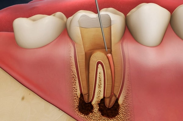 Cách điều trị cho răng bị chết tủy