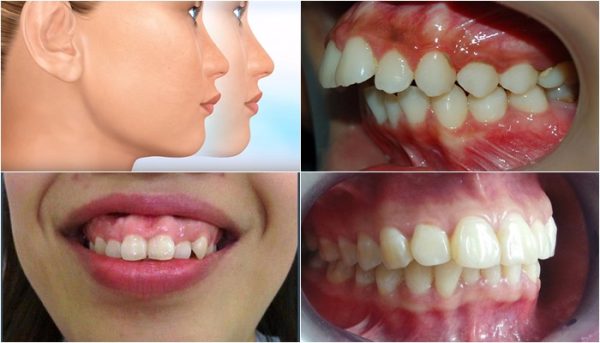 Hô hàm là một khuyết điểm của răng và rất dễ thấy bằng mắt thường