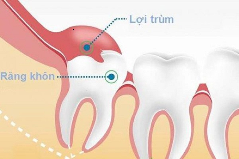 Lợi trùm răng khôn là gì?
